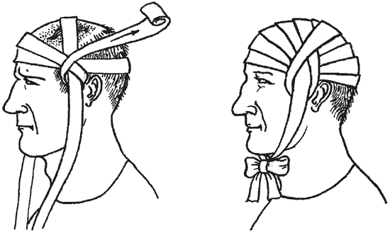 Повязка накладывается при повреждении затылка. Повязка при переломе костей черепа. Повязка на голову при травме чепец. Наложение повязки чепец. Шапочка Гиппократа повязка.