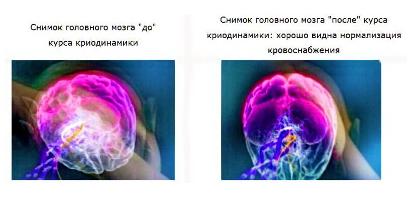 Криодинамика. Современный способ не стареть