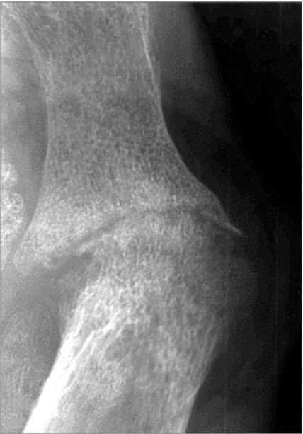 Диффузный остеопороз суставов. Остеопороз локтевого сустава рентген. Диффузный остеопороз суставов. Остеопороз колена на рентгене. Диффузный остеопороз на рентгенограмме.