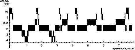 Rem фаза сна это. Rem стадия сна. Rem фаза. Гипнограмма.